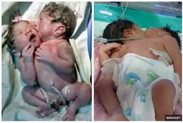 Unbelievable! Baby Born With Two Heads Leave Doctors In Deep Shock (Photos)
